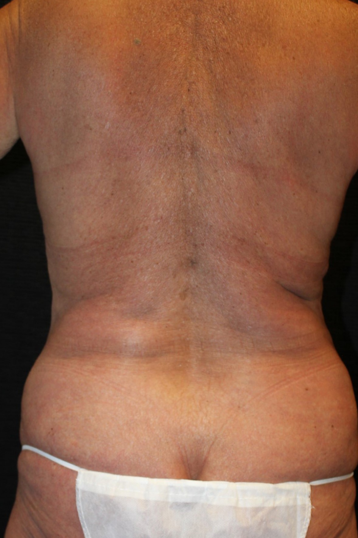 Patient #40123: Liposuction After Image