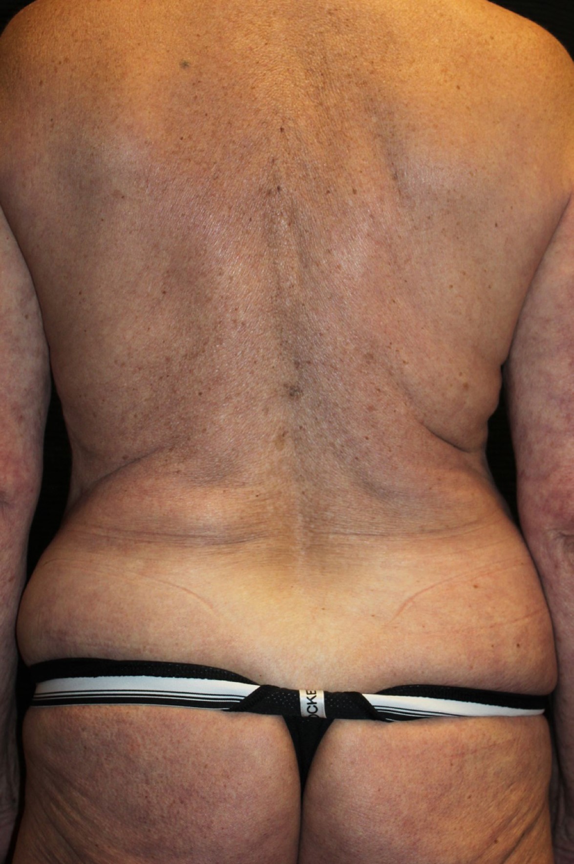 Patient #40123: Liposuction Before Image