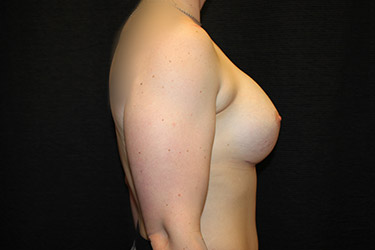 Patient #18048: Breast Augmentation After Image