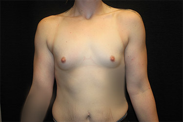 Patient #18048: Breast Augmentation Before Image