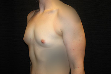 Patient #18048: Breast Augmentation Before Image