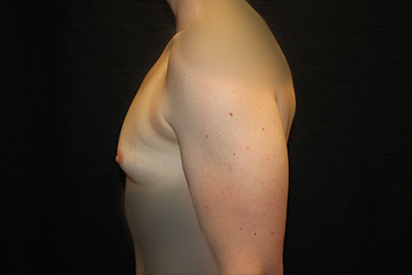 Patient #18048: Breast Augmentation Before Image