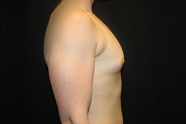 Patient #18048: Breast Augmentation Before Image