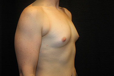 Patient #18048: Breast Augmentation Before Image