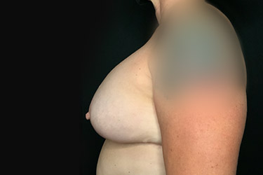 Patient #79823: Breast Implant Exchange with Lift and Capsulectomy After Image