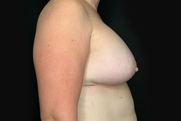 Patient #79823: Breast Implant Exchange with Lift and Capsulectomy After Image