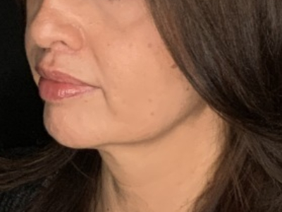 Patient #78698: Lip Lift After Image