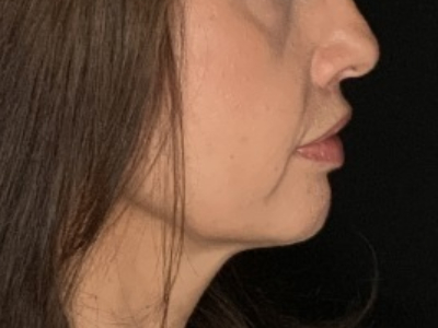 Patient #78698: Lip Lift After Image