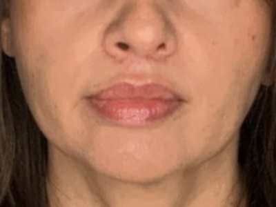 Patient #78698: Lip Lift After Image