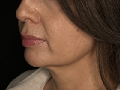 Patient #78698: Lip Lift Before Image