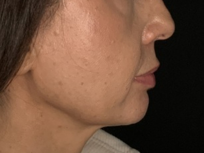 Patient #78698: Lip Lift Before Image