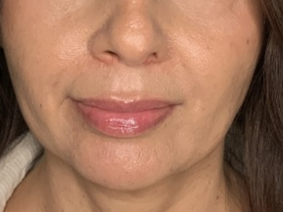 Patient #78698: Lip Lift Before Image