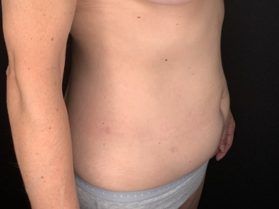 Patient #36598: Liposuction to Axillary Rolls, Abdomen, Back, Hips and Flanks After Image