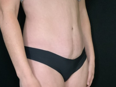 Patient #12339: Liposuction After Image