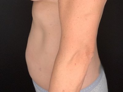Patient #36598: Liposuction to Axillary Rolls, Abdomen, Back, Hips and Flanks After Image