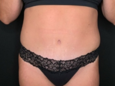 Patient #84274: Tummy Tuck with Liposuction and Hernia Repair After Image