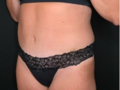 Patient #84274: Tummy Tuck with Liposuction and Hernia Repair After Image