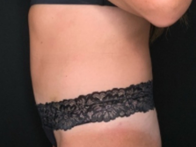 Patient #84274: Tummy Tuck with Liposuction and Hernia Repair After Image