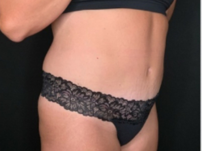 Patient #84274: Tummy Tuck with Liposuction and Hernia Repair After Image
