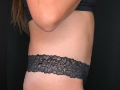 Patient #84274: Tummy Tuck with Liposuction and Hernia Repair After Image