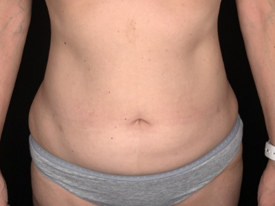 Patient #36598: Liposuction to Axillary Rolls, Abdomen, Back, Hips and Flanks After Image