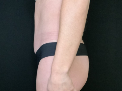 Patient #12339: Liposuction After Image