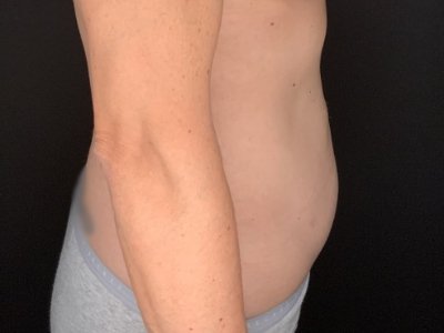 Patient #36598: Liposuction to Axillary Rolls, Abdomen, Back, Hips and Flanks After Image