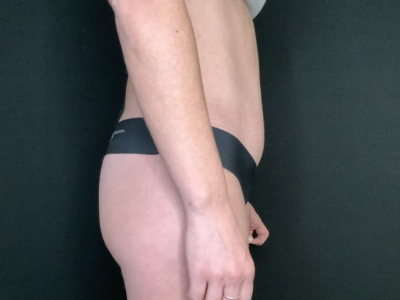 Patient #12339: Liposuction After Image