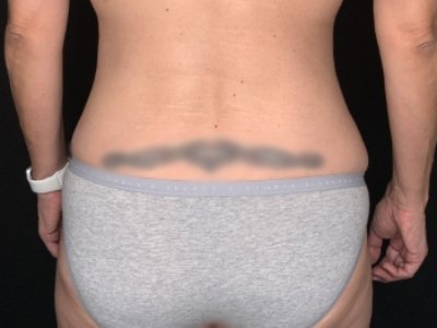Patient #36598: Liposuction to Axillary Rolls, Abdomen, Back, Hips and Flanks After Image