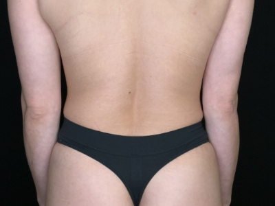 Patient #56985: Flank Liposuction After Image
