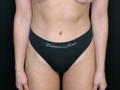 Patient #56985: Flank Liposuction After Image