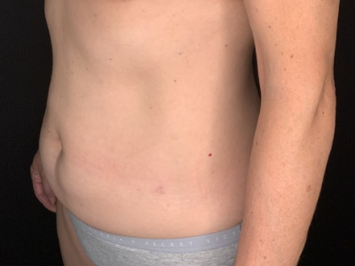 Patient #36598: Liposuction to Axillary Rolls, Abdomen, Back, Hips and Flanks After Image