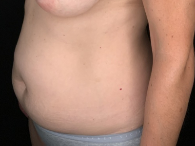 Patient #36598: Liposuction to Axillary Rolls, Abdomen, Back, Hips and Flanks Before Image