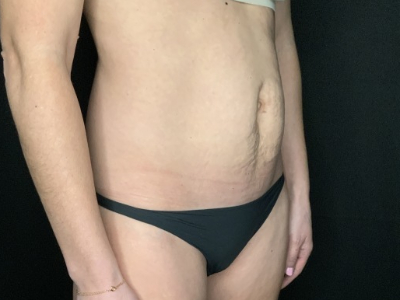 Patient #12339: Liposuction Before Image
