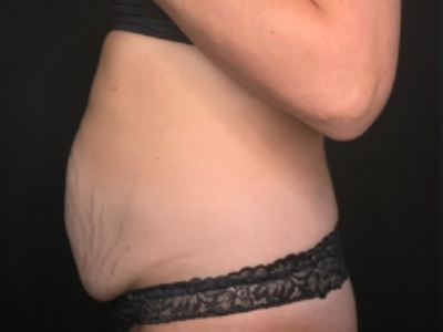 Patient #84274: Tummy Tuck with Liposuction and Hernia Repair Before Image