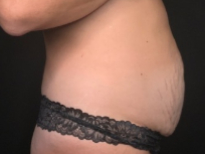 Patient #84274: Tummy Tuck with Liposuction and Hernia Repair Before Image