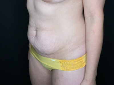 Patient #56985: Flank Liposuction Before Image