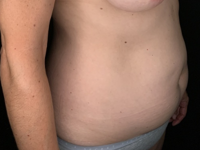 Patient #36598: Liposuction to Axillary Rolls, Abdomen, Back, Hips and Flanks Before Image