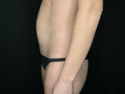 Patient #12339: Liposuction Before Image