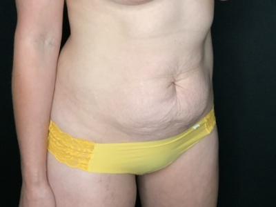 Patient #56985: Flank Liposuction Before Image