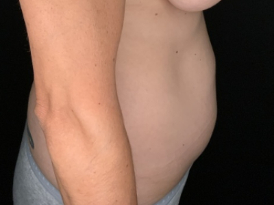 Patient #36598: Liposuction to Axillary Rolls, Abdomen, Back, Hips and Flanks Before Image