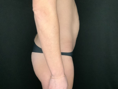 Patient #12339: Liposuction Before Image