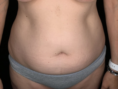 Patient #36598: Liposuction to Axillary Rolls, Abdomen, Back, Hips and Flanks Before Image