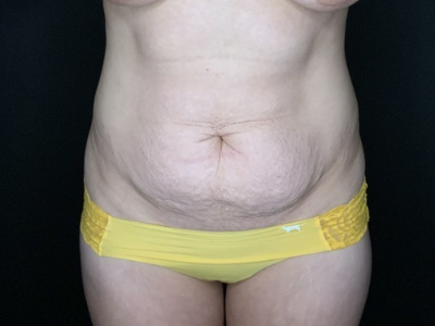 Patient #56985: Flank Liposuction Before Image