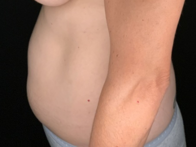 Patient #36598: Liposuction to Axillary Rolls, Abdomen, Back, Hips and Flanks Before Image