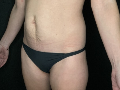 Patient #12339: Liposuction Before Image