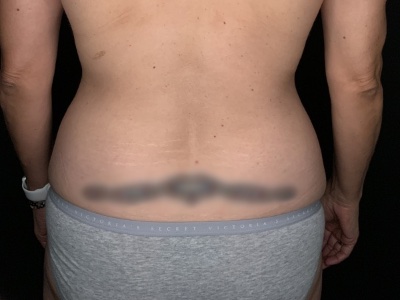 Patient #36598: Liposuction to Axillary Rolls, Abdomen, Back, Hips and Flanks Before Image