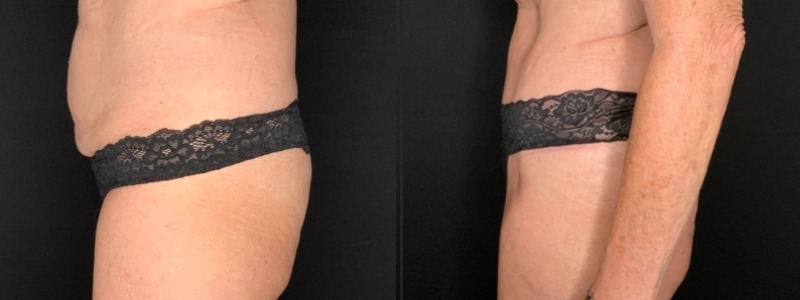 Patient #12479: Tummy Tuck with Liposuction to Flanks Combine Image