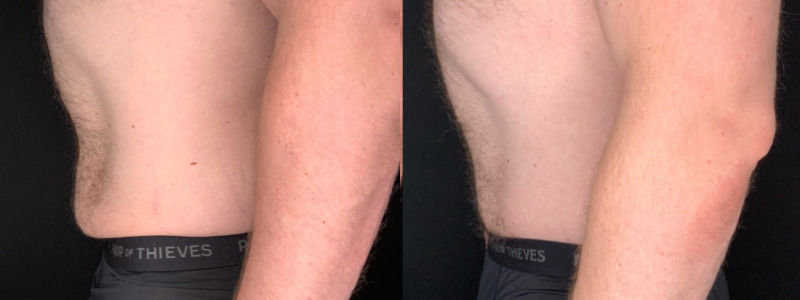 Patient #41269: Tummy Tuck with Liposuction Combine Image