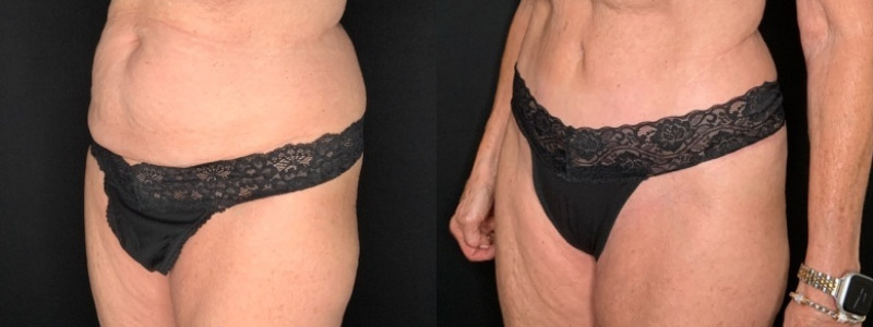 Patient #12479: Tummy Tuck with Liposuction to Flanks Combine Image